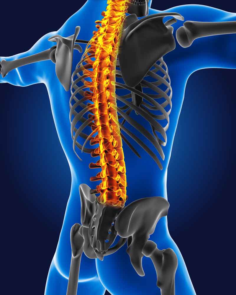 Spinal stenosis