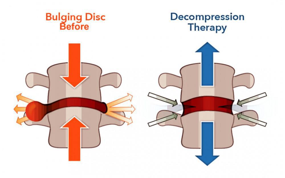 spine decompression surgery