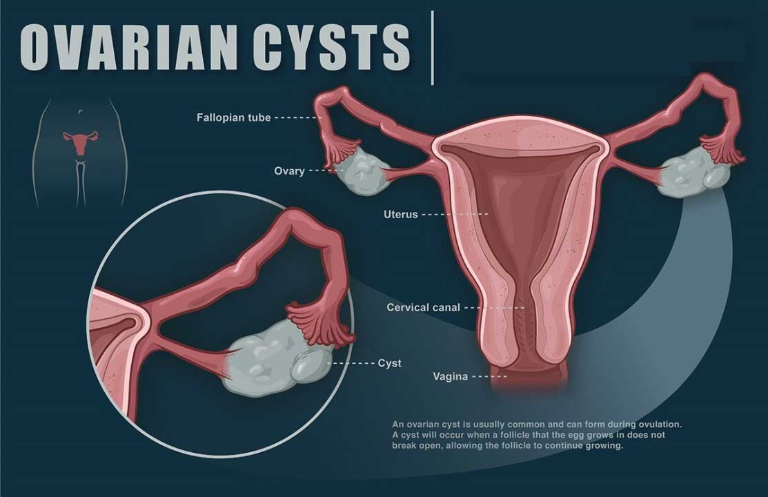 Understanding Cysts